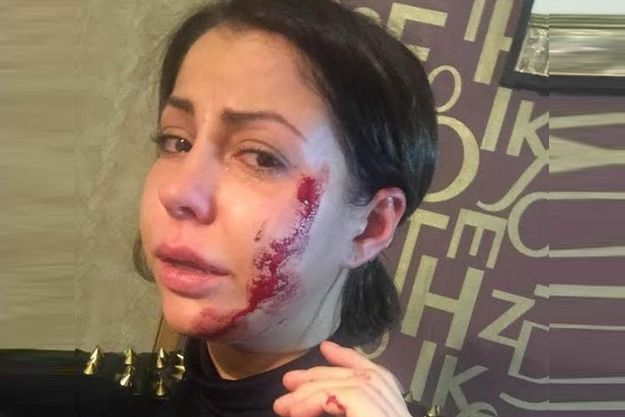 Елену Беркову жестоко избила пьяная женщина