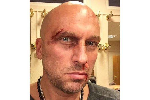 Дмитрий Нагиев шокировал фанатов избитым лицом